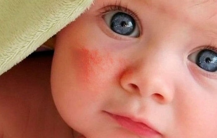 Bé bị chàm sữa