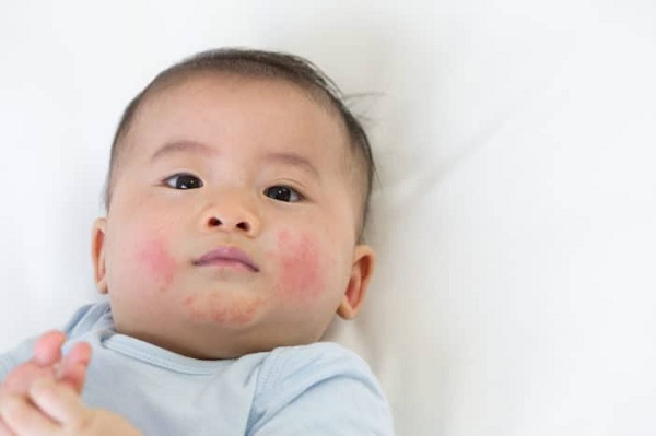 nguyên nhân bé bị chàm sữa