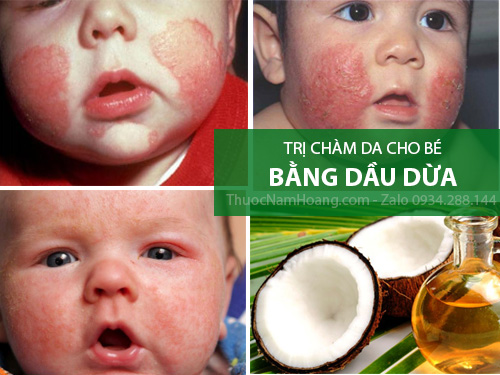 Cách trị bệnh bé bị chàm sữa bằng dầu dừa