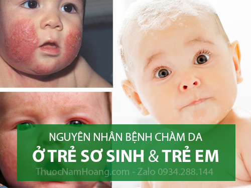 bé bị chàm mãi không khỏi