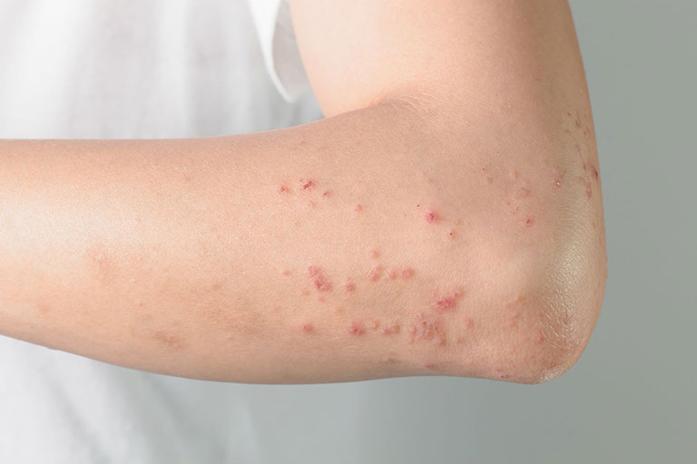 nổi mụn nước ngứa ở cánh tay