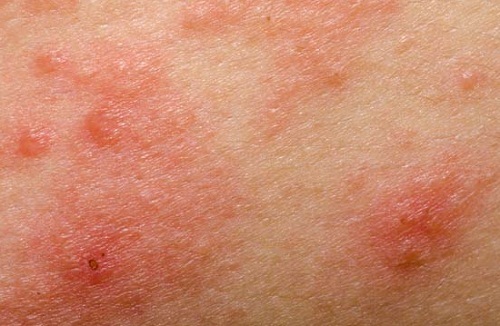 nguyên nhân bị chàm nước