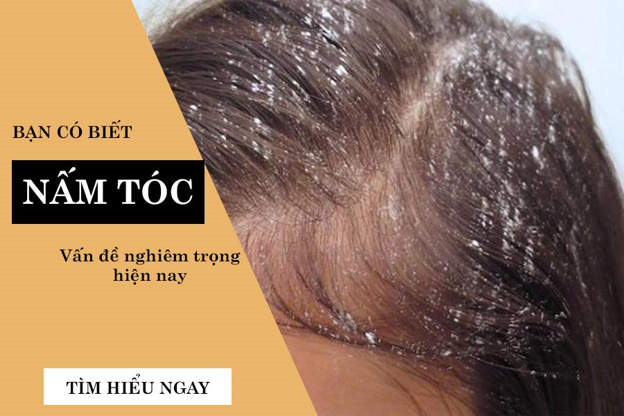 bệnh nấm tóc