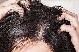 Da đầu bị ngứa và nổi mụn