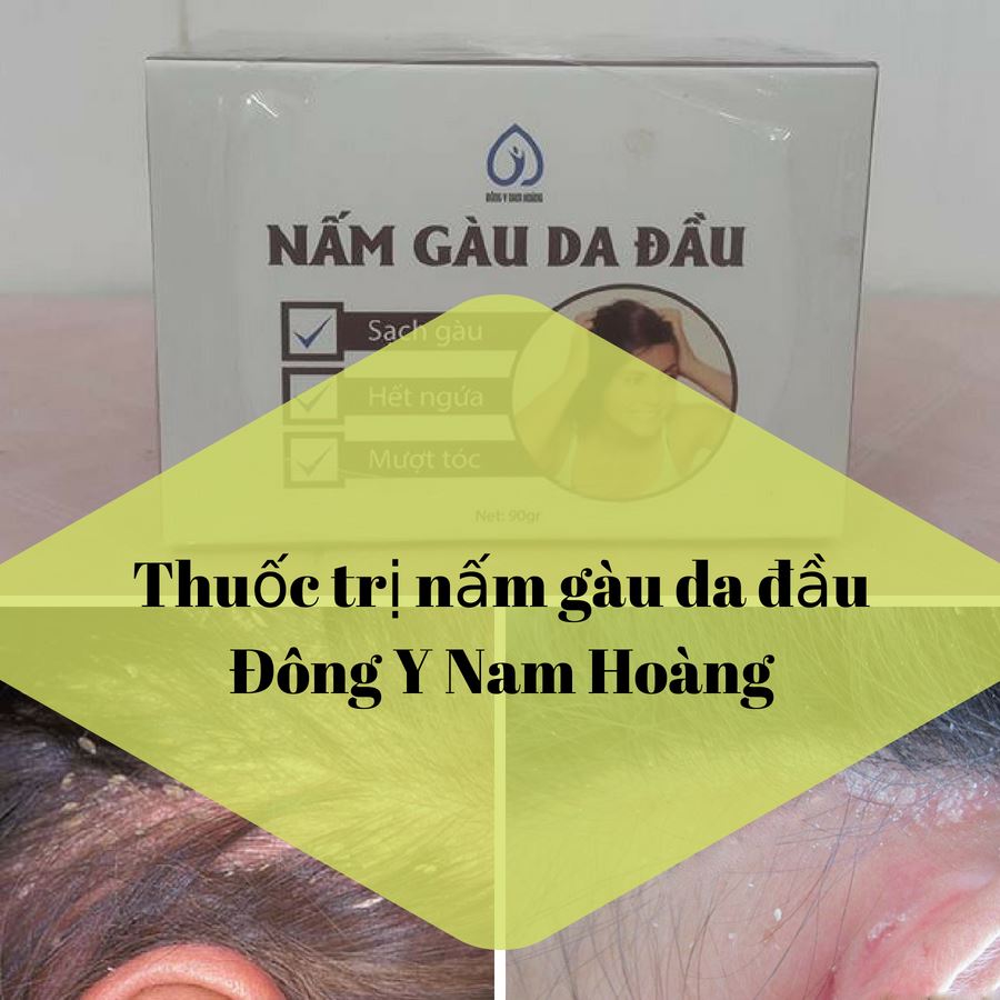 thuốc trị da đầu bị ngứa