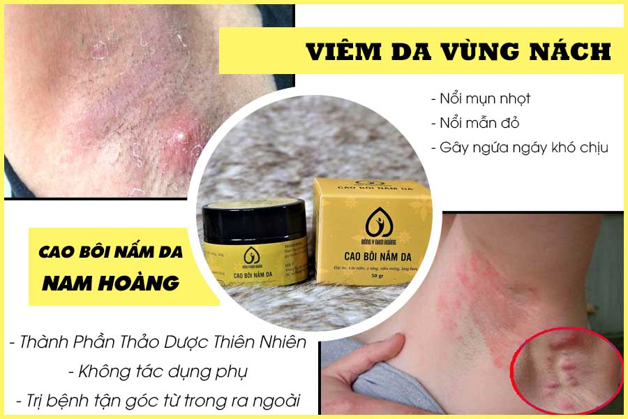 thuốc trị viêm da vùng nách