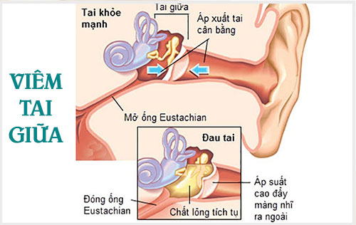 cách trị Viêm tai giữa ở người lớn