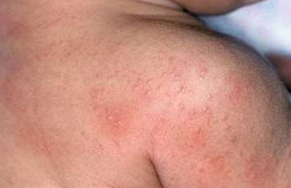 bé bị nổi mẩn đỏ ở lưng