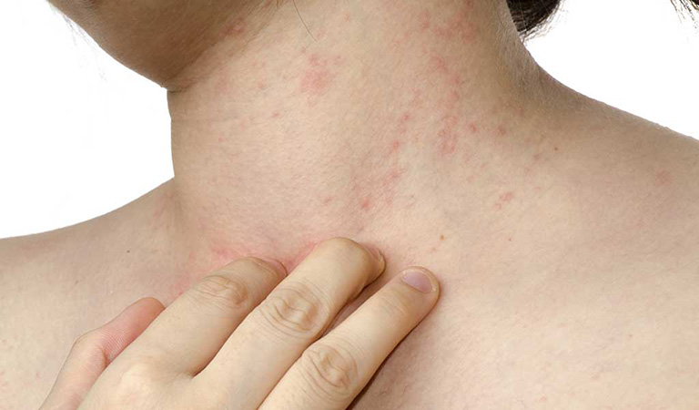 phòng bệnh nổi mụn nước ngứa