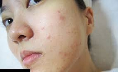 nguyên nhân Da mặt ngứa và nổi mẩn đỏ