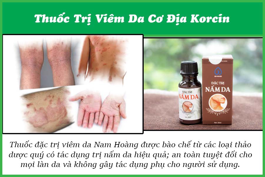 Thuốc điều trị viêm da cơ địa Korcin