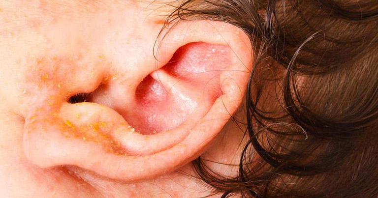 Nổi mụn nước ở vành tai do viêm ống tai ngoài