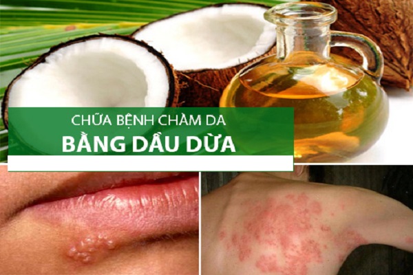 Trị chàm khô bằng dầu dừa