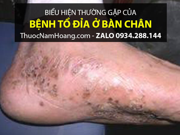 hình ảnh bệnh tổ đỉa ở chân