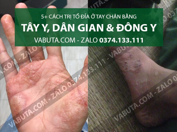 cách trị tổ đỉa ở chân