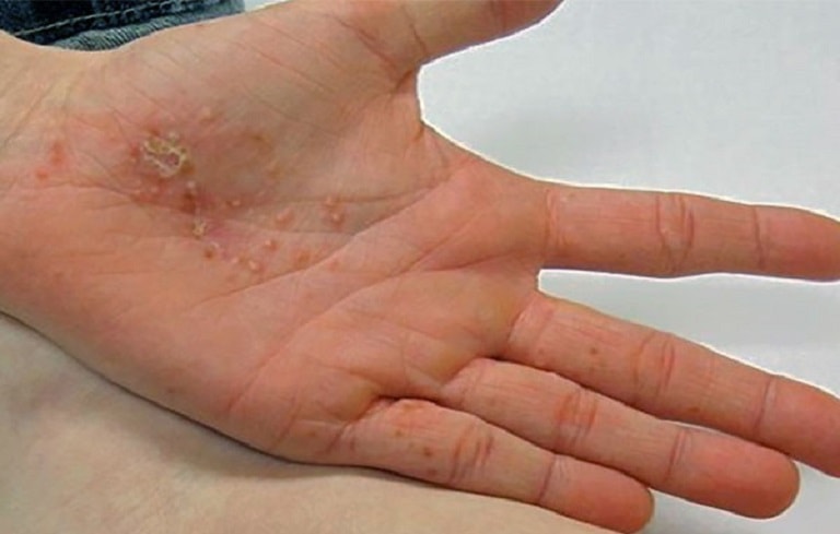 trị tổ đỉa ở tay bằng tây y