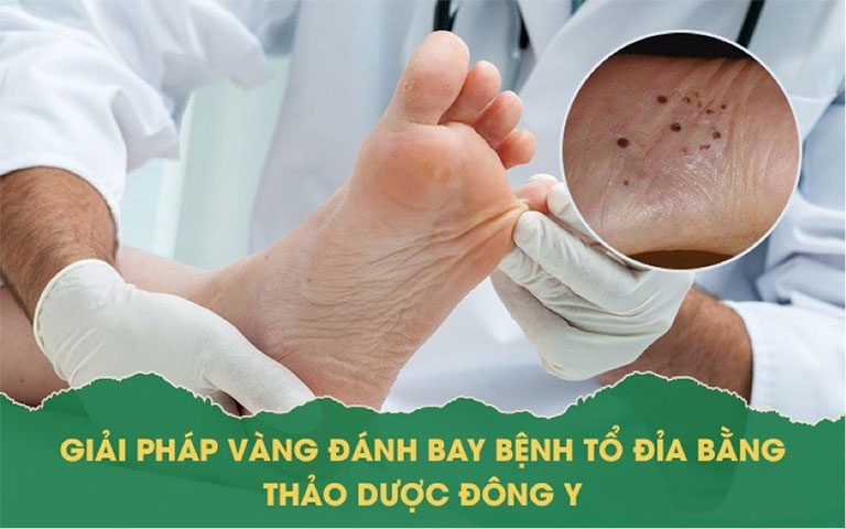 cách trị bệnh tổ đỉa bằng dân gian