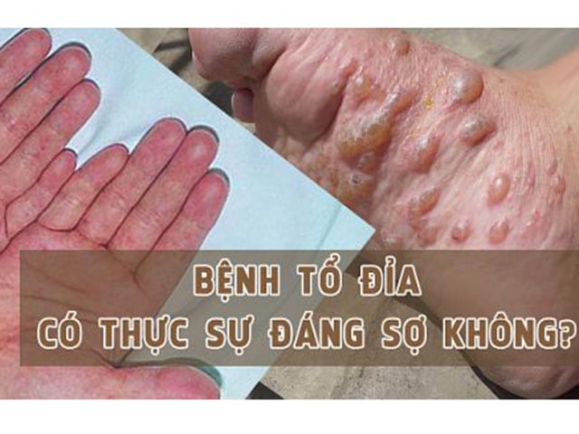 cách trị bệnh tổ đỉa tận gốc