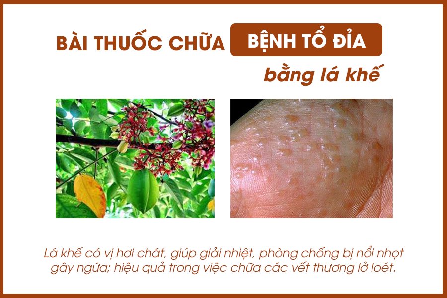 Cách chữa trị bệnh tổ đỉa bằng lá khế