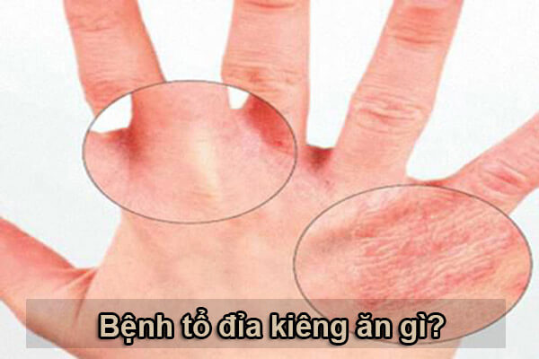 bệnh tổ đỉa kiêng ăn gì