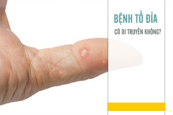 bệnh tổ đỉa có tự khỏi không