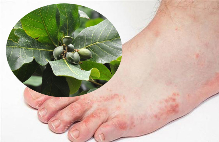Đắp lá bàng non chữa bệnh tổ đỉa