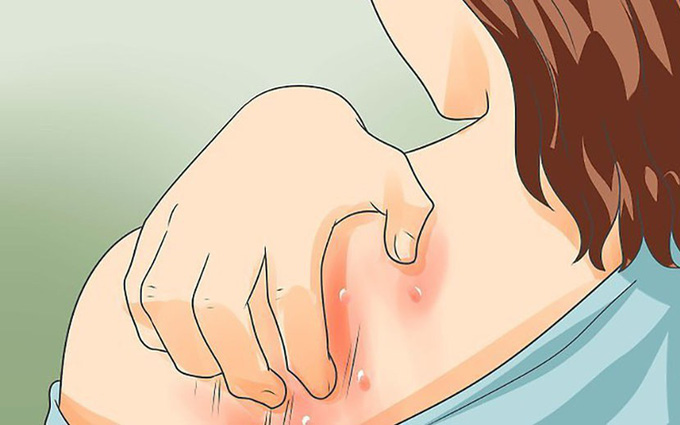 Chữa ghẻ nước bằng muối
