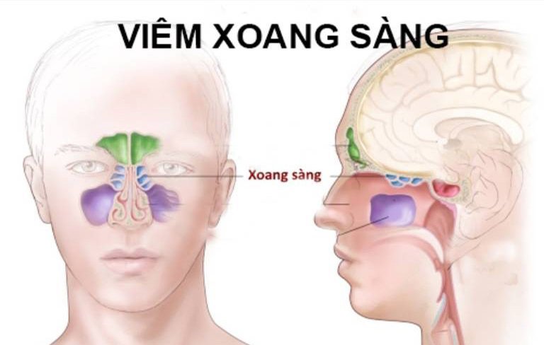 Viêm xoang sàng sau