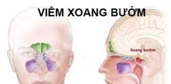 viêm xoang bướm