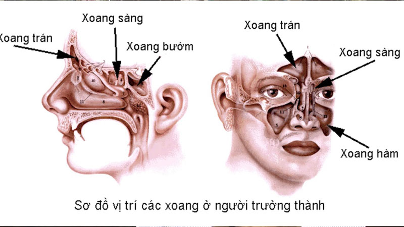biến chứng viêm xoang bướm