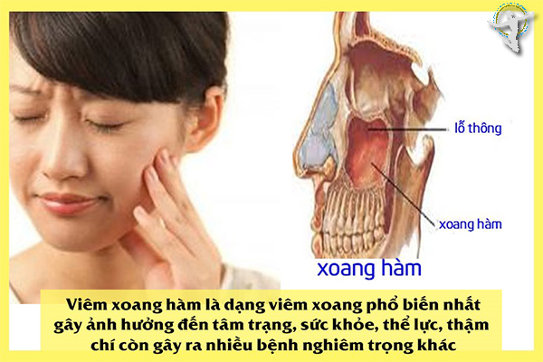 cách trị viêm xoang hàm