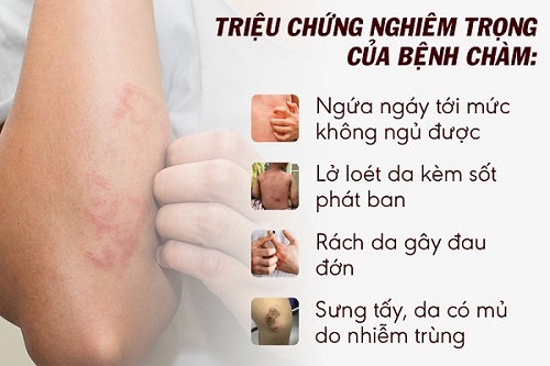 triệu chứng bệnh chàm là gì