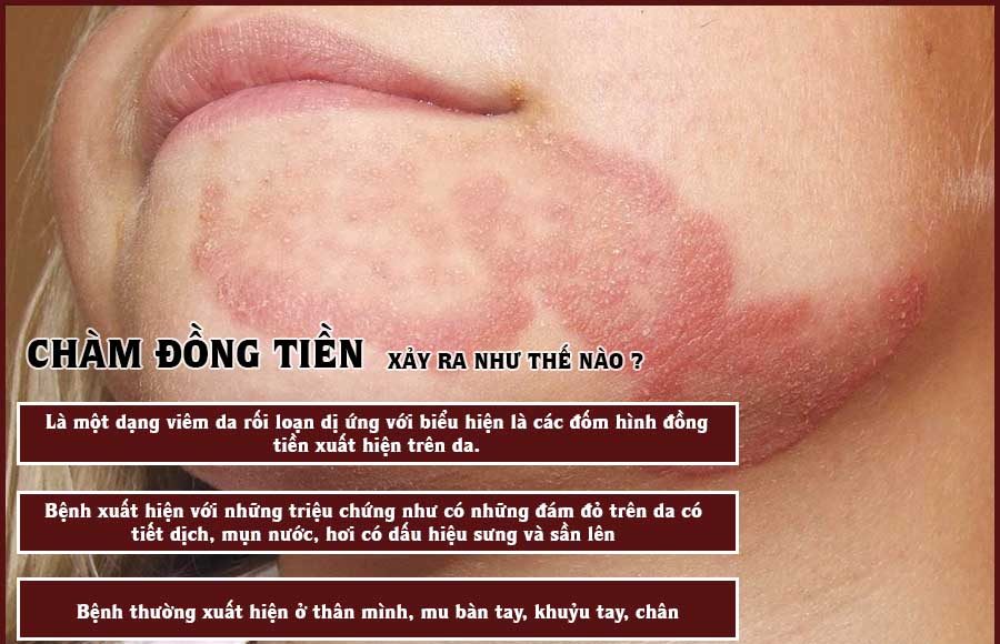 hình ảnh Bệnh chàm đồng tiền