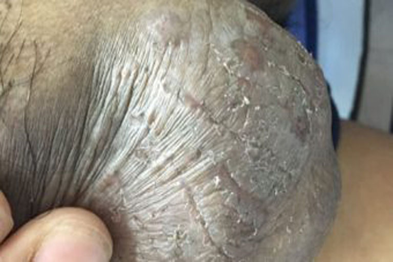 Hình ảnh chàm sinh dục