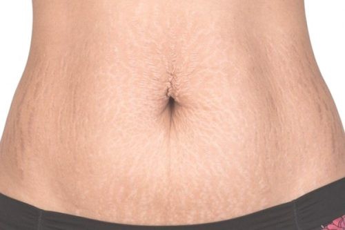 cách trị rạn da lâu năm