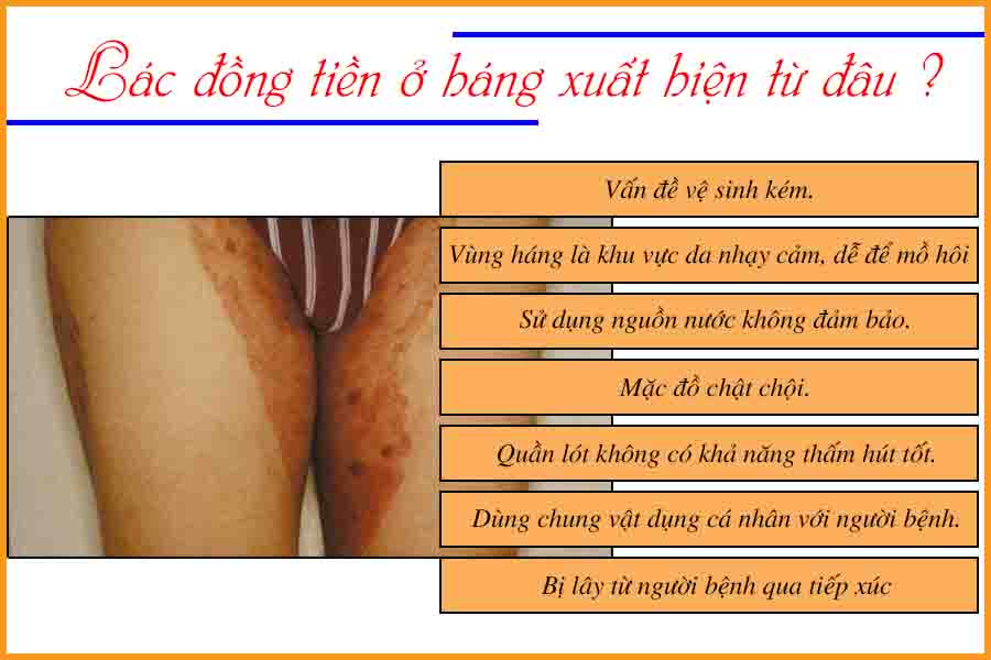 nguyên nhân bệnh lác đồng tiền ở háng