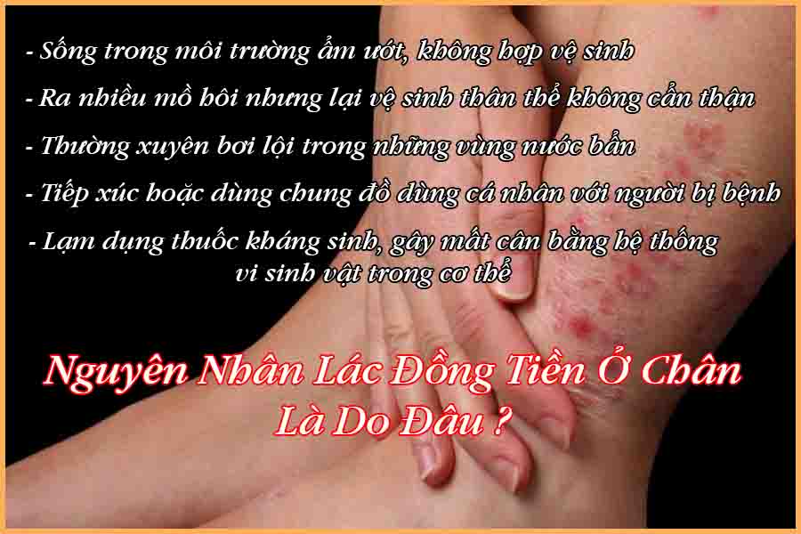 Nguyên nhân lác đồng tiền ở chân
