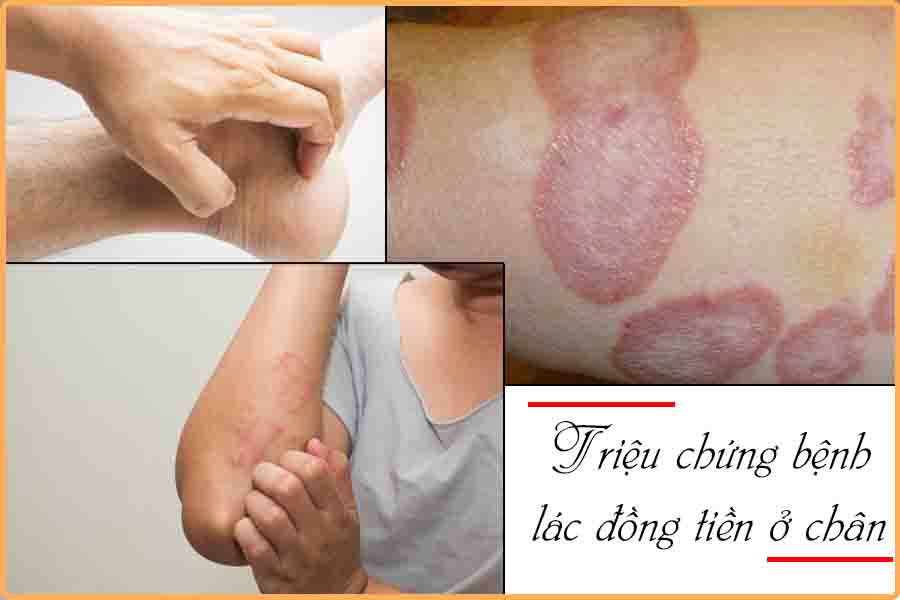 triệu chứng bệnh lác đồng tiền ở chân