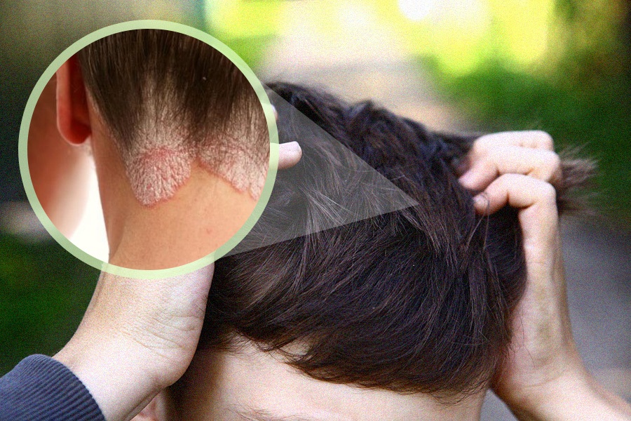 Triệu chứng á sừng da đầu
