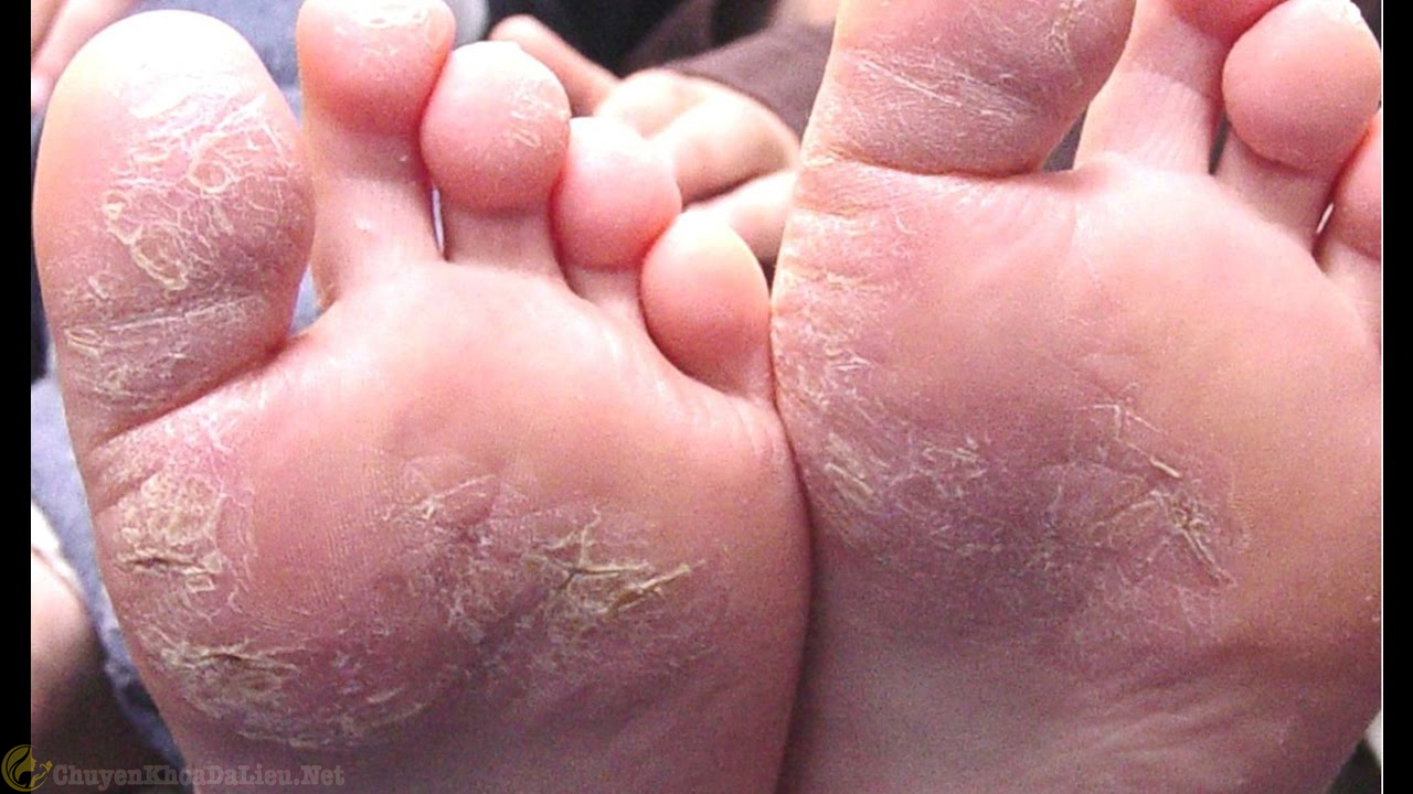 Biểu hiện nhận biết bệnh á sừng ở chân