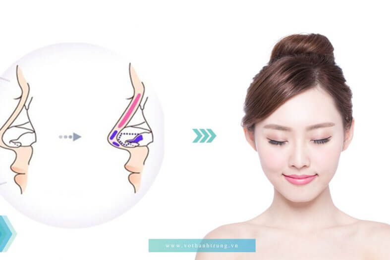 bị viêm xoang có nâng mũi được không