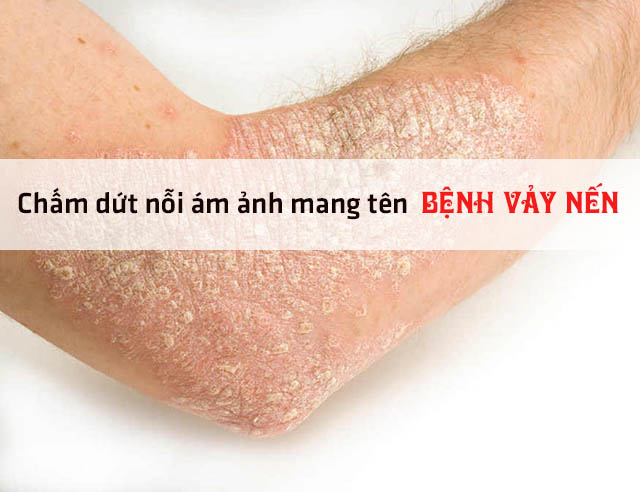 Thuốc sinh học trị vảy nến