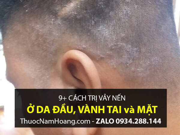 sử dụng muối biển Chết trị nấm da đầu