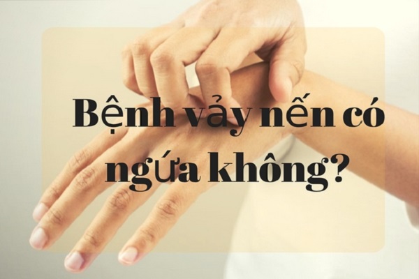 Bệnh vảy nến có ngứa không