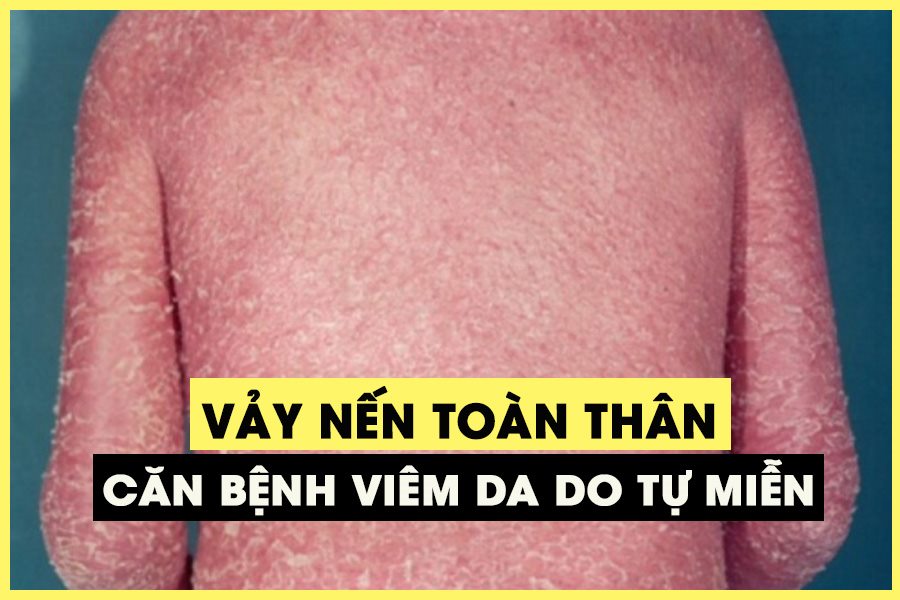 bệnh vảy nến toàn thân