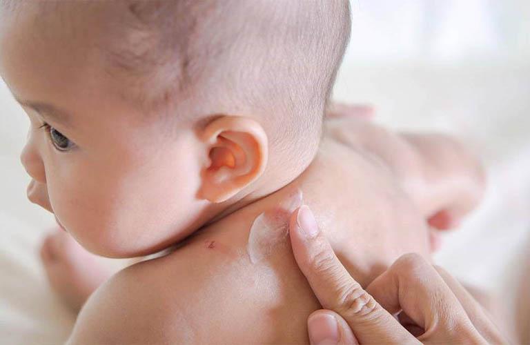 thuốc bôi tại chỗ trị vảy nến trẻ em