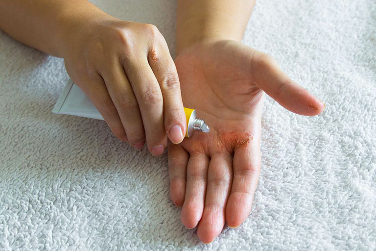 Chữa viêm da cơ địa ở tay nên dùng thuốc gì?