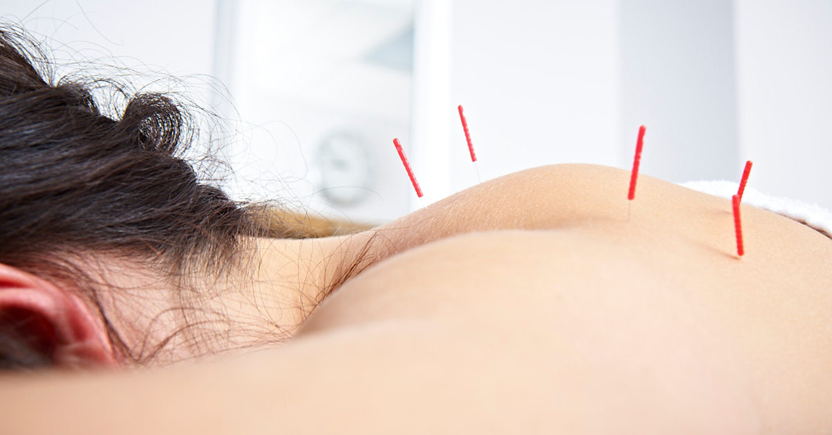 Bị đau vai gáy có cần châm cứu không?