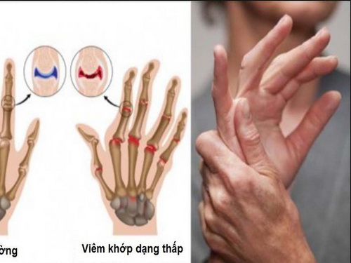 Dấu hiệu bệnh viêm xương khớp dạng thấp