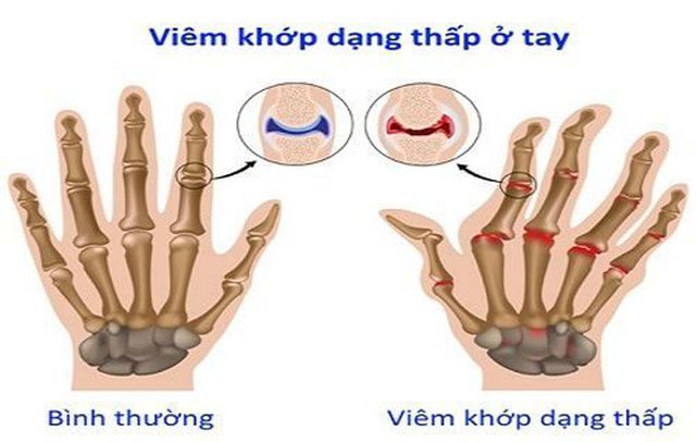 thời kỳ nhận biết viêm khớp dạng thấp
